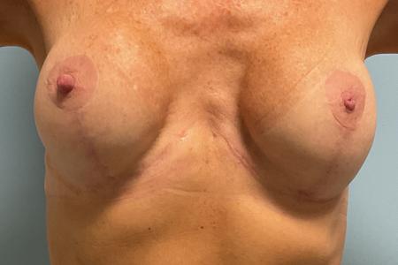 After image 1 Case #134366 - 64 y.o. female w/ VI Peel for Breast Scars