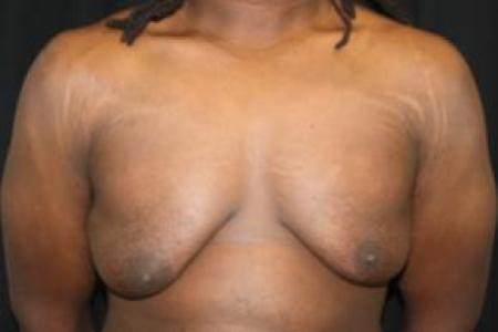 Before image 1 Case #83056 - 22 year old Gynecomastia