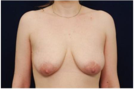 Before image 1 Case #82061 - Breast Lift