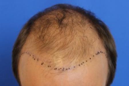 Before Case #87396 - Hair Transplantation San Diego