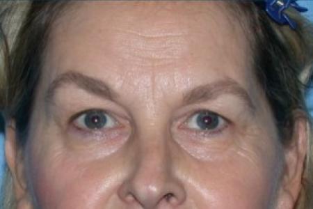 Before image 4 Case #86141 - CO2 Laser For Skin Rejuvenation, Browlift, & Upper Blepharoplasty