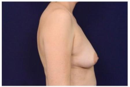 Before image 3 Case #87051 - Breast Augmentation