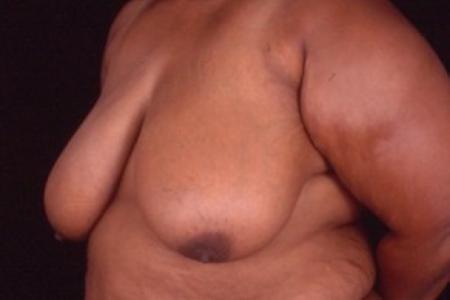 Before image 2 Case #81461 - Breast Reduction/Lift