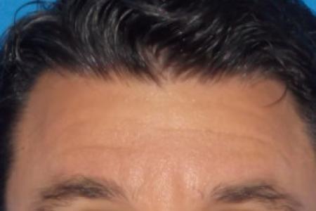 Before Case #88336 - Botox to Forehead