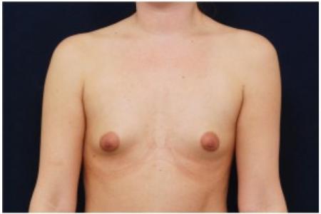 Before image 1 Case #81961 - Breast Augmentation