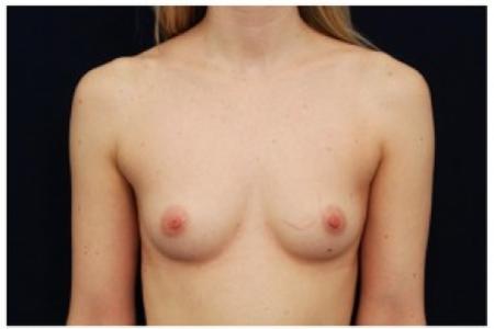 Before image 1 Case #81971 - Breast Augmentation