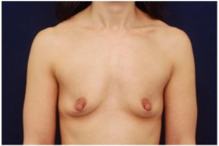 Before image 1 Case #82026 - Breast Augmentation