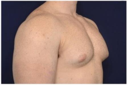 Before image 2 Case #86196 - 32 year old man treated with Male Breast Reduction