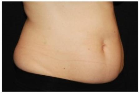 Before image 2 Case #86351 - 37 year old woman treated with nonsurgical fat reduction.