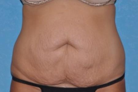 Before image 1 Case #83421 - Abdominoplasty