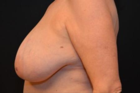 Before image 3 Case #82581 - Breast Reduction