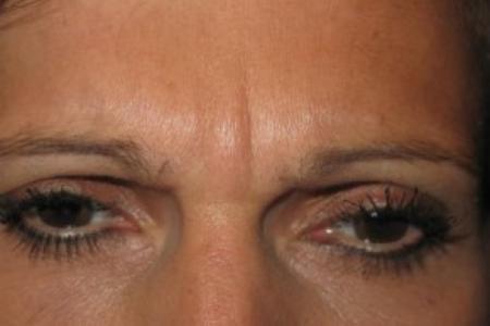 Before image 1 Case #82626 - Botox - glabella
