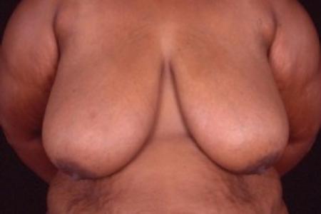 Before image 1 Case #81461 - Breast Reduction/Lift