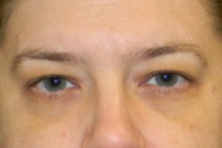 Before image 1 Case #88331 - Upper Eyelid Lift