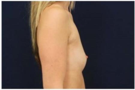 Before image 3 Case #81996 - Breast Augmentation