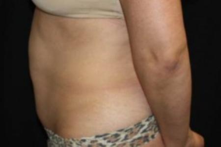 Before image 3 Case #85836 - Abdominoplasty - 39 year old female