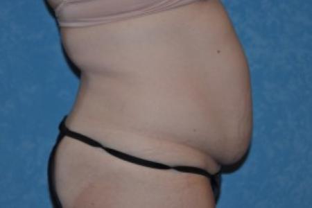 Before image 2 Case #83951 - Liposuction Before and After 