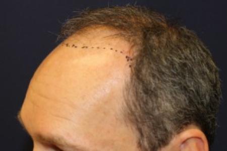 Before Case #87381 - Hair Transplantation San Diego