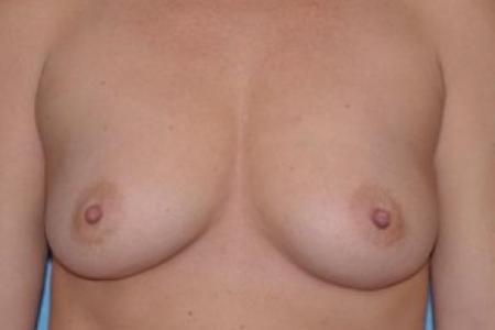 Before image 1 Case #83376 - Breast Augmentation 