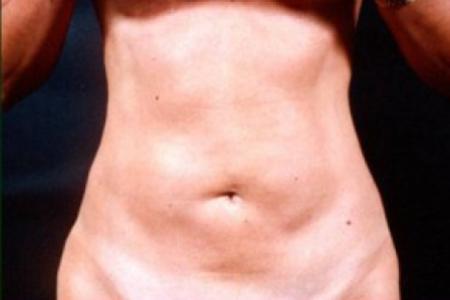 Before image 1 Case #81656 - Liposuction