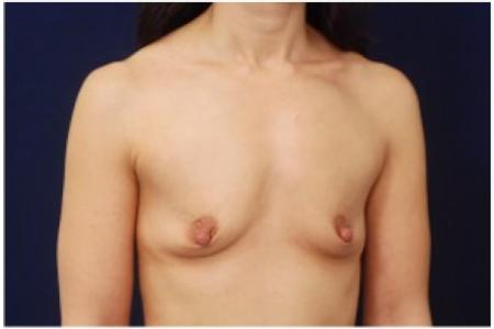Before image 2 Case #82026 - Breast Augmentation