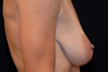 Before image 3 Case #81766 - Breast Lift