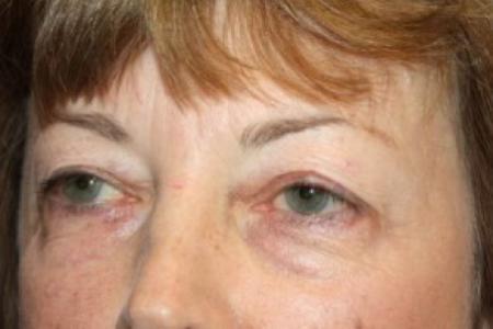 Before image 2 Case #84711 - Blepharoplasty - 59 year old female.