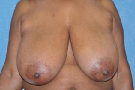 Before image 1 Case #83411 - Breast Reduction 