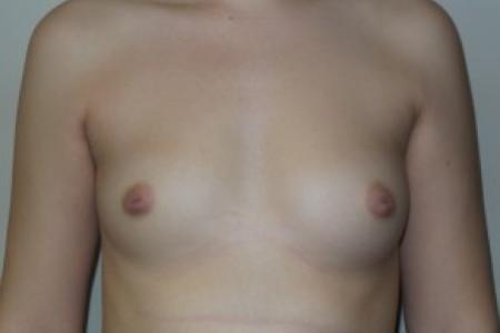 Before image 1 Case #82426 - 20 Female Breast Augmentation