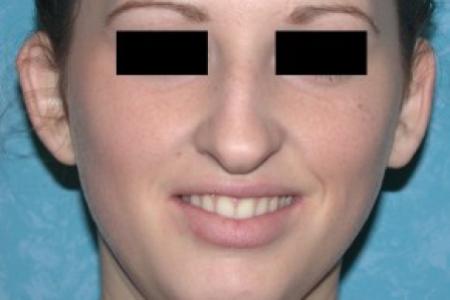Before image 1 Case #81676 - Bilateral Otoplasties