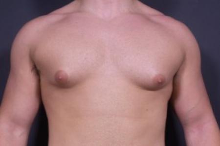 Before image 1 Case #84181 - Gynecomastia