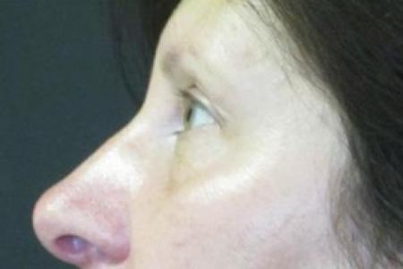 Before image 2 Case #82616 - Upper and lower eyelids
