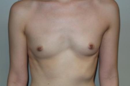 Before image 1 Case #82421 - 33 Female Breast Augmentation