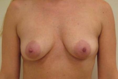 Before image 1 Case #82741 - Mastopexy (periareolar) with augmentation