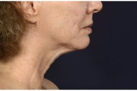 Before image 3 Case #86401 - 50 year old woman treated with lower facial rejuvenation