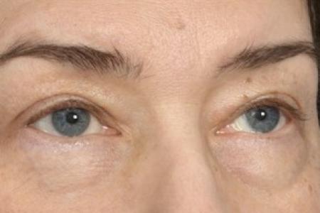 Before image 3 Case #87451 - Eye Area Rejuvenation