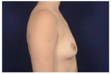 Before image 3 Case #87001 - Breast Augmentation