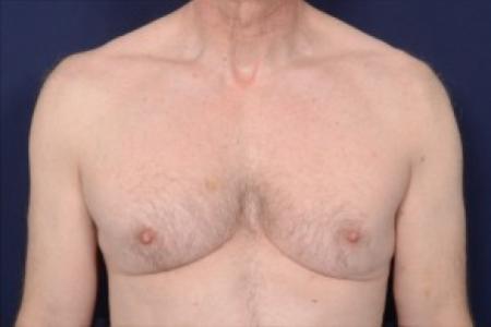 Before image 1 Case #87516 - Gynecomastia