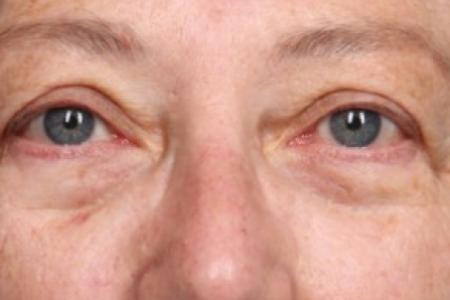 Before image 1 Case #86771 - Upper Blepharoplasty ( Eyelid Lift )
