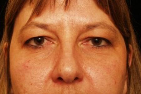Before image 1 Case #81741 - Eyelid Surgery