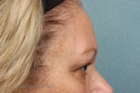Before image 2 Case #88181 - Upper and Lower Eyelid Lift with Lateral Brow Lift