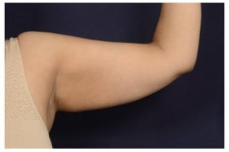 Before image 1 Case #87066 - Upper Arm Lift