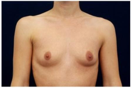 Before image 1 Case #81991 - Breast Augmentation