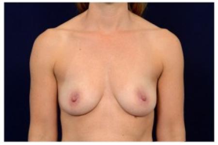 Before image 1 Case #87011 - Breast Augmentation