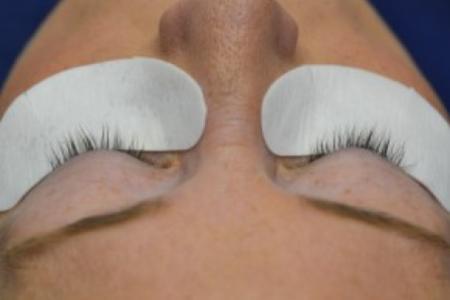 Before image 1 Case #86376 - 45 year old woman treated with eyelash enhancement