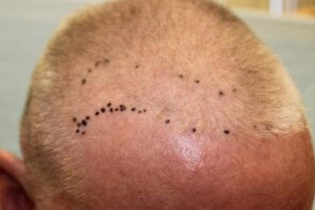 Before Case #87386 - Hair Transplantation San Diego