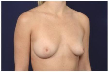 Before image 2 Case #86266 - 29 year old woman treated with Breast Augmentation