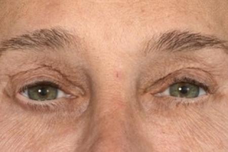 Before image 1 Case #87131 - Structural Fat Grafting