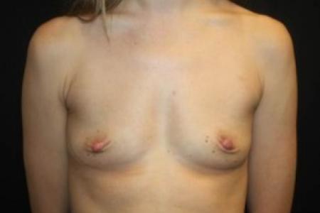 Before image 1 Case #84926 - Breast Augmentation - 33 year old female