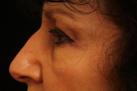 Before image 2 Case #81736 - Eyelid Surgery